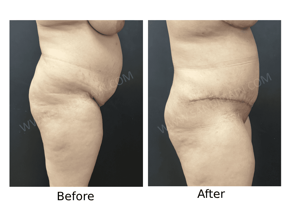 Before: same patient is in fig 1<br>After