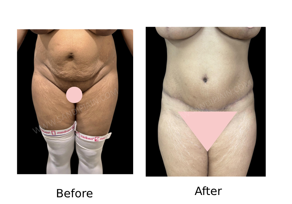 Before 1 <br>After 1: following tummy tuck