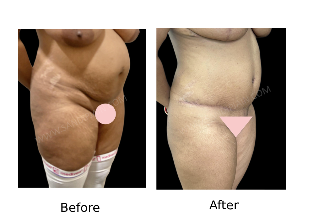Before 2 : same patient as in fig 1<br>After 2
