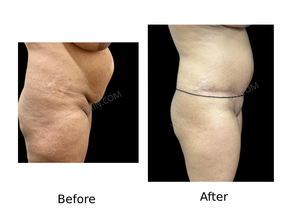 Before 3 : same patient as in fig1<br>AFTER 3