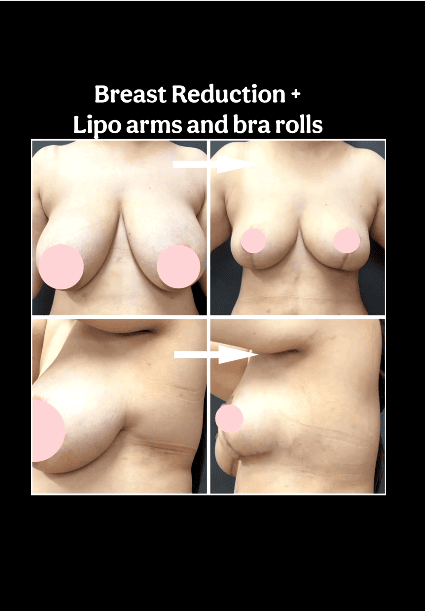 BREAST REDUCTION PLUS!