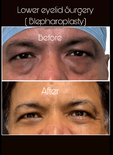 Lower Eyelid Surgery( Blepharoplasty)